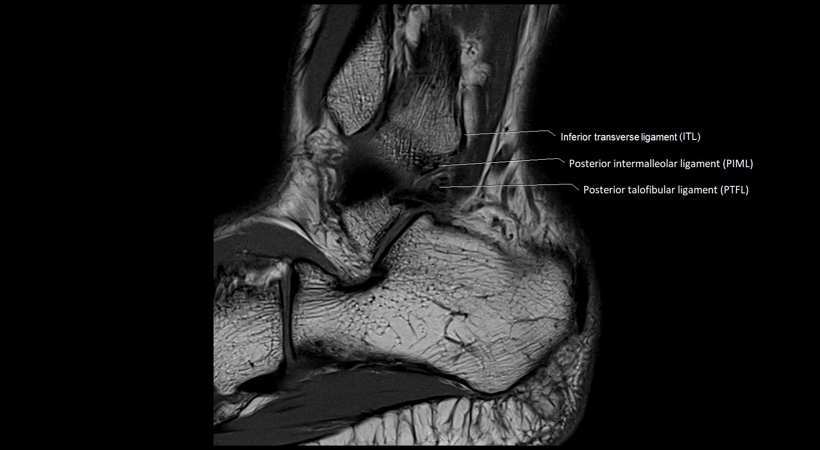 MRI ankle ligaments anatomy sagittal 3T image 22.webp